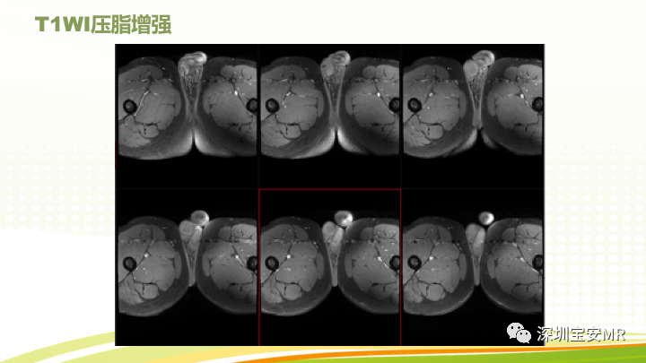 【PPT】影像病例学习：睾丸病变2例