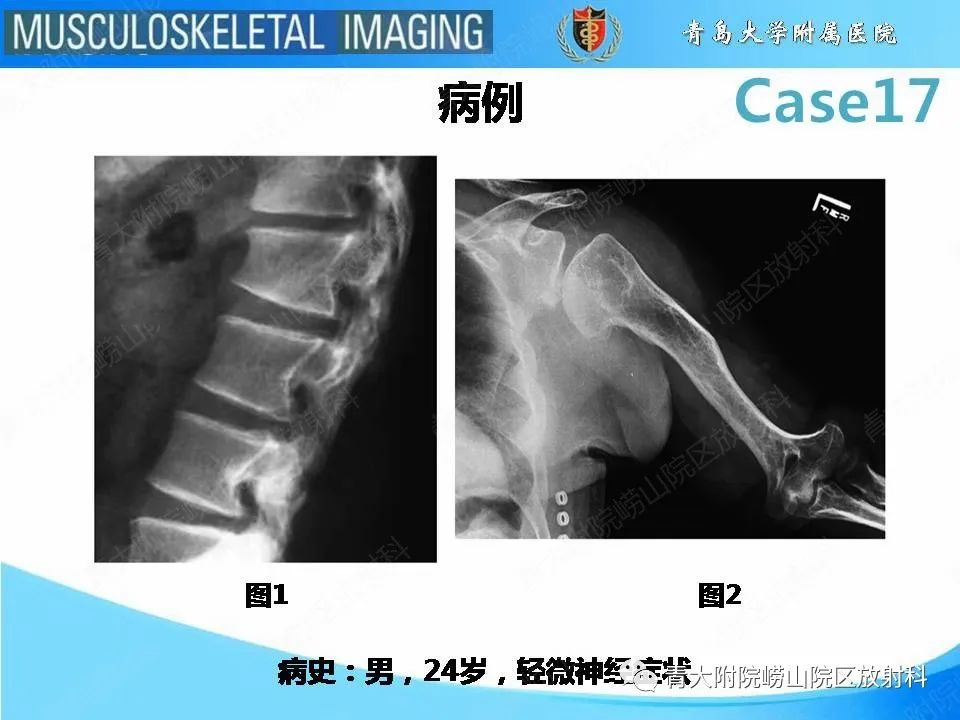 【PPT】软骨发育不全