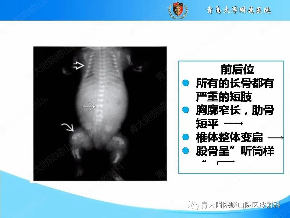 【PPT】软骨发育不全