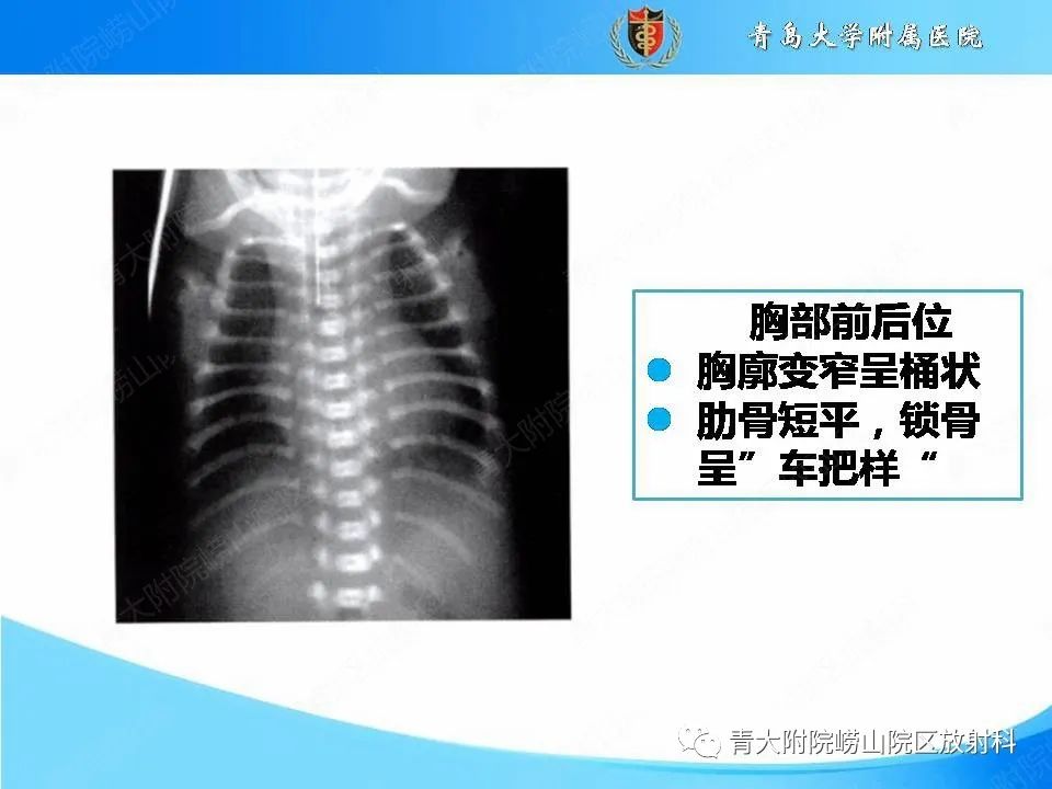 【PPT】软骨发育不全
