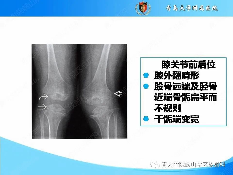 【PPT】软骨发育不全