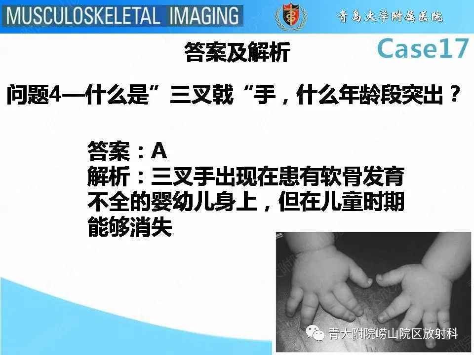 【PPT】软骨发育不全
