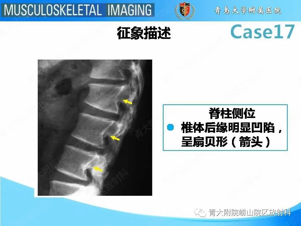 【PPT】软骨发育不全