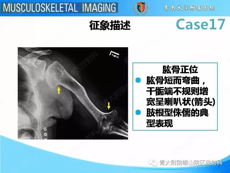 【PPT】软骨发育不全