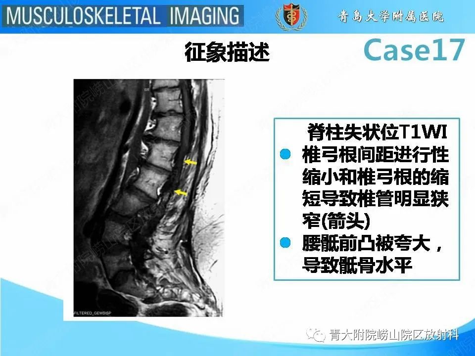 【PPT】软骨发育不全