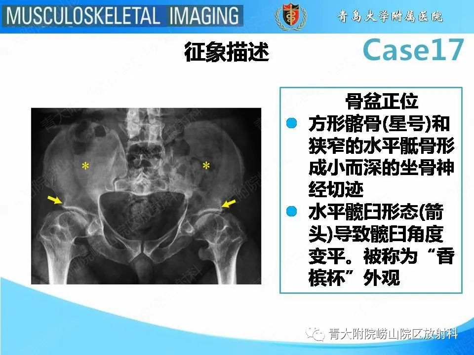 【PPT】软骨发育不全