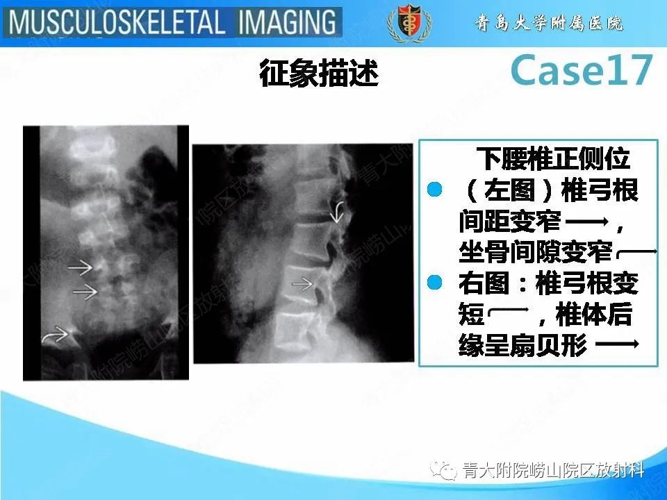 【PPT】软骨发育不全