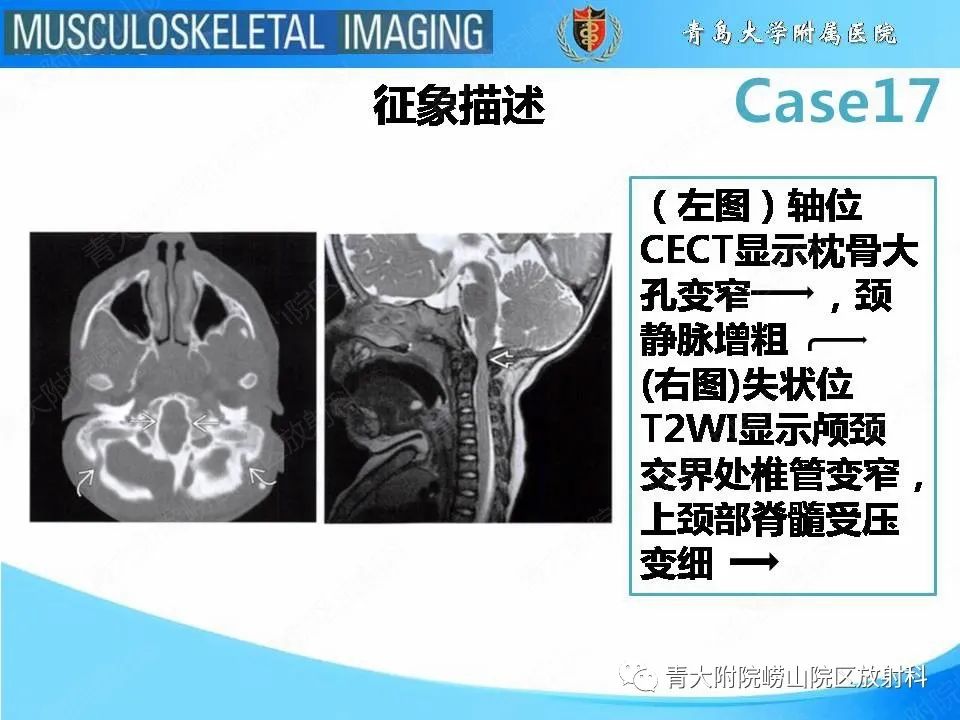 【PPT】软骨发育不全