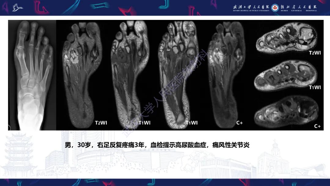 【PPT】关节痛风影像诊断
