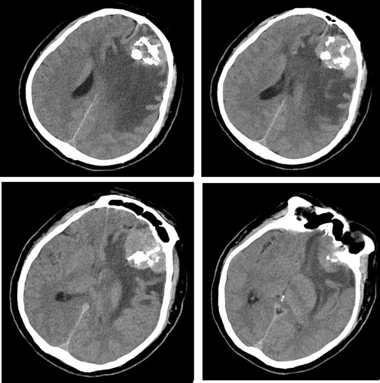脑膜瘤与血管外皮瘤的 MRI 诊断与鉴别诊断 脑膜瘤与血管外皮瘤的 MRI 诊断与鉴别诊断