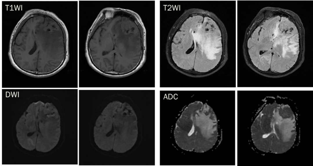 脑膜瘤与血管外皮瘤的 MRI 诊断与鉴别诊断 脑膜瘤与血管外皮瘤的 MRI 诊断与鉴别诊断