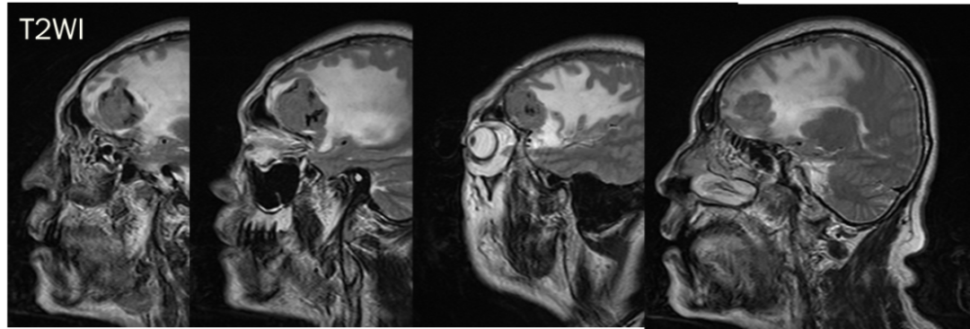 脑膜瘤与血管外皮瘤的 MRI 诊断与鉴别诊断 脑膜瘤与血管外皮瘤的 MRI 诊断与鉴别诊断