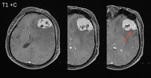 脑膜瘤与血管外皮瘤的 MRI 诊断与鉴别诊断 脑膜瘤与血管外皮瘤的 MRI 诊断与鉴别诊断