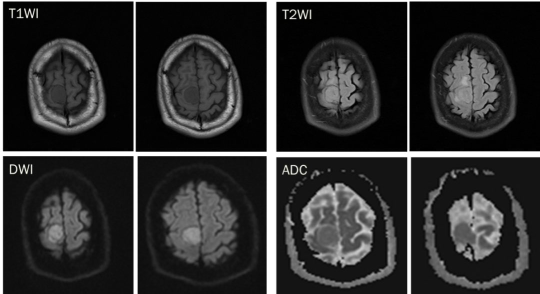 脑膜瘤与血管外皮瘤的 MRI 诊断与鉴别诊断 脑膜瘤与血管外皮瘤的 MRI 诊断与鉴别诊断