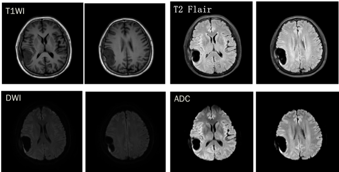 脑膜瘤与血管外皮瘤的 MRI 诊断与鉴别诊断 脑膜瘤与血管外皮瘤的 MRI 诊断与鉴别诊断