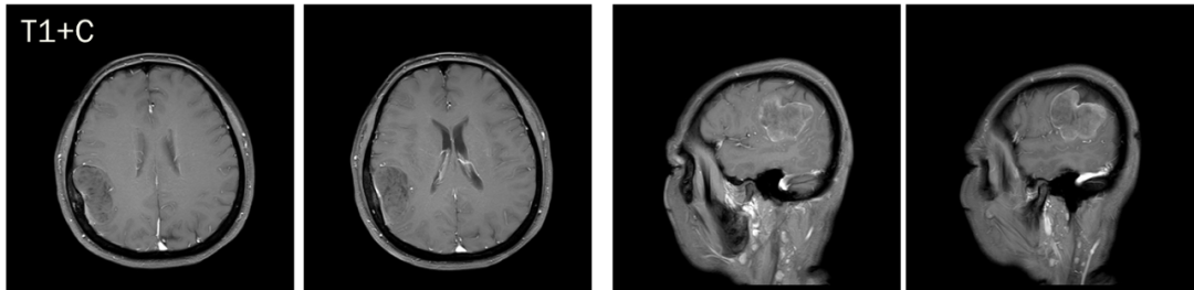 脑膜瘤与血管外皮瘤的 MRI 诊断与鉴别诊断 脑膜瘤与血管外皮瘤的 MRI 诊断与鉴别诊断