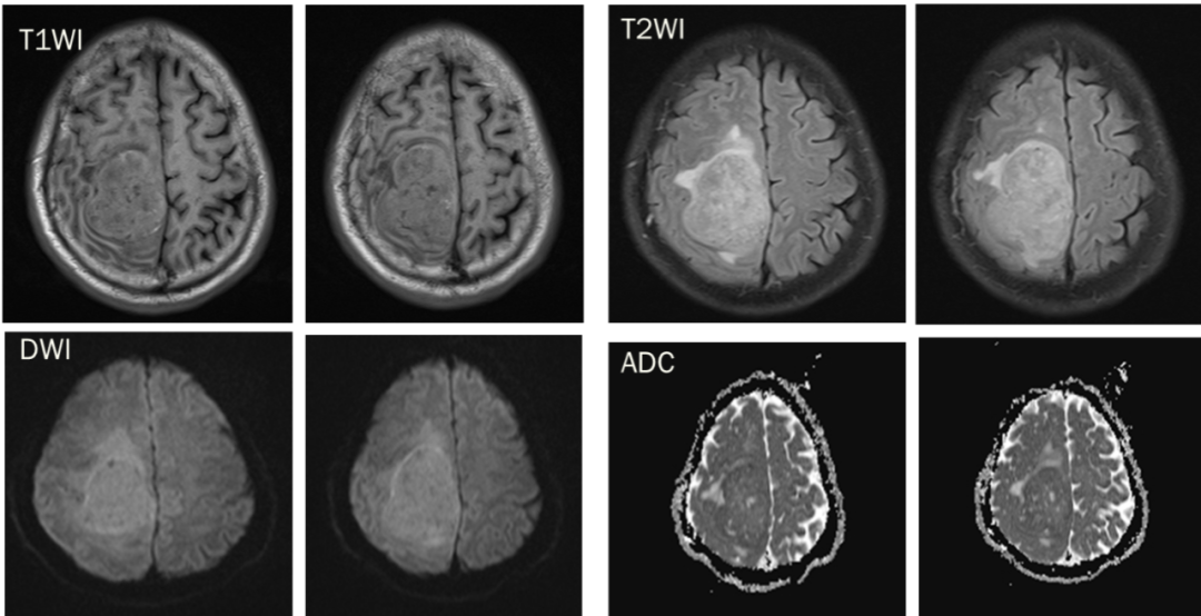 脑膜瘤与血管外皮瘤的 MRI 诊断与鉴别诊断 脑膜瘤与血管外皮瘤的 MRI 诊断与鉴别诊断