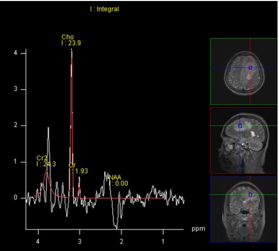 脑膜瘤与血管外皮瘤的 MRI 诊断与鉴别诊断 脑膜瘤与血管外皮瘤的 MRI 诊断与鉴别诊断