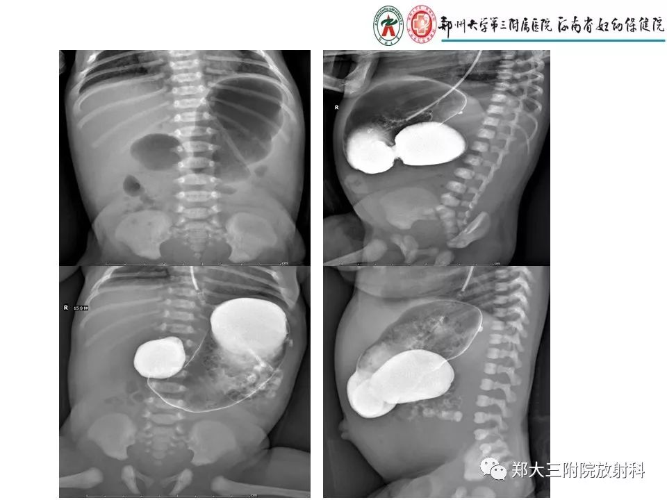 【PPT】十二指肠梗阻病例分析