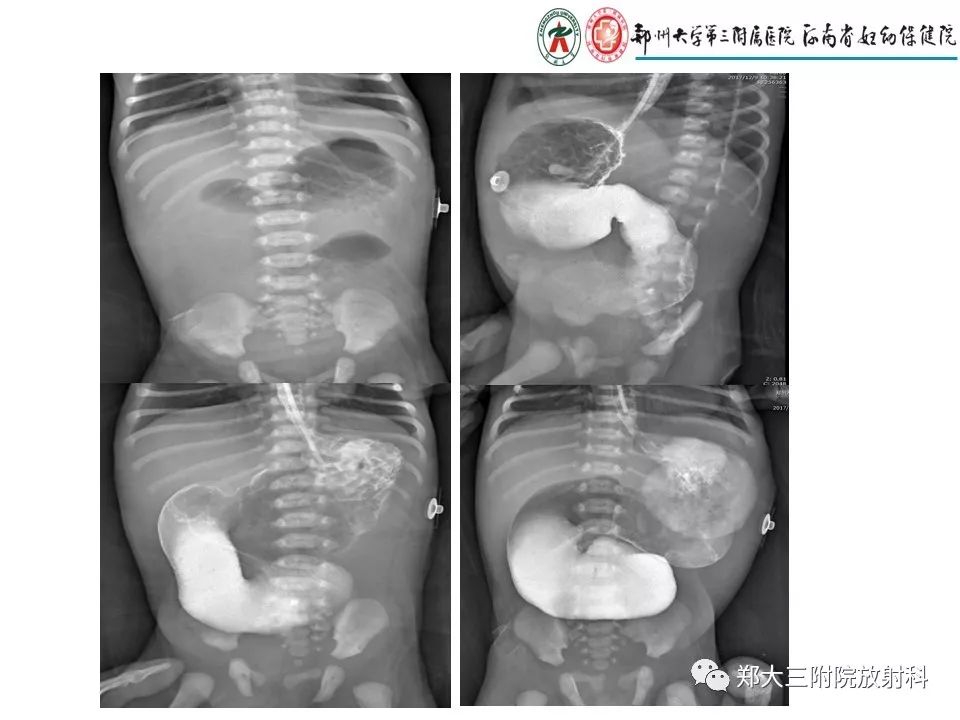【PPT】十二指肠梗阻病例分析