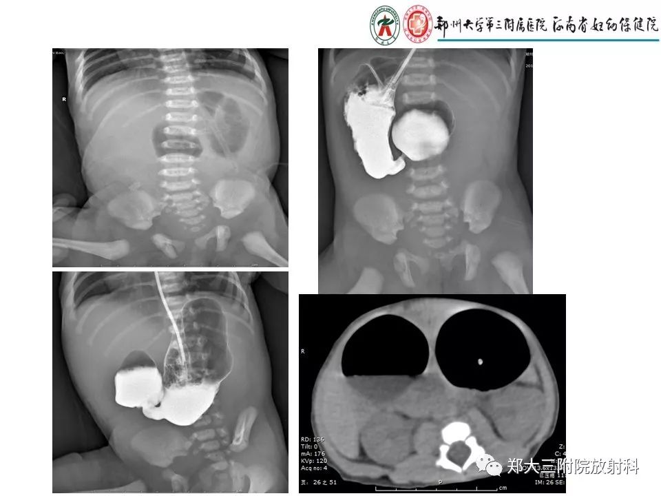 【PPT】十二指肠梗阻病例分析