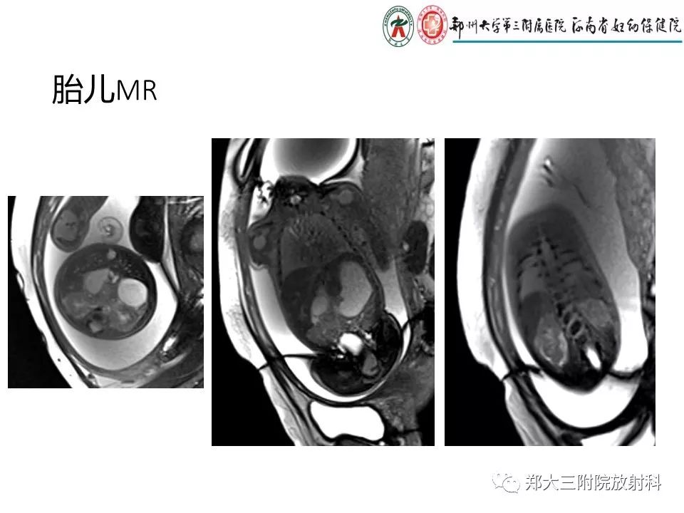 【PPT】十二指肠梗阻病例分析