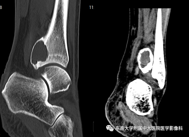 【PPT】动脉瘤样骨囊肿