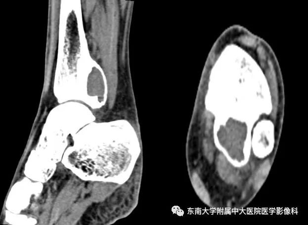 【PPT】动脉瘤样骨囊肿