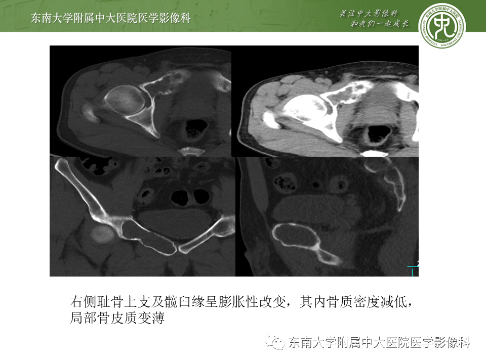 【PPT】动脉瘤样骨囊肿