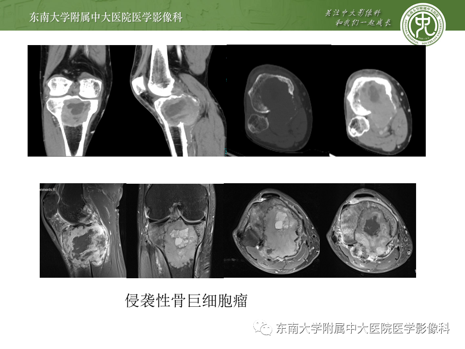 【PPT】动脉瘤样骨囊肿