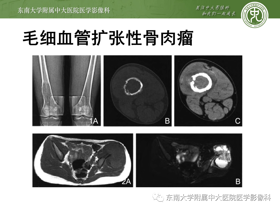【PPT】动脉瘤样骨囊肿