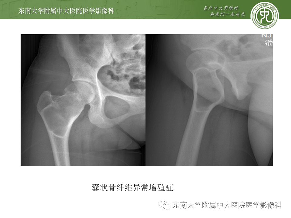 【PPT】动脉瘤样骨囊肿