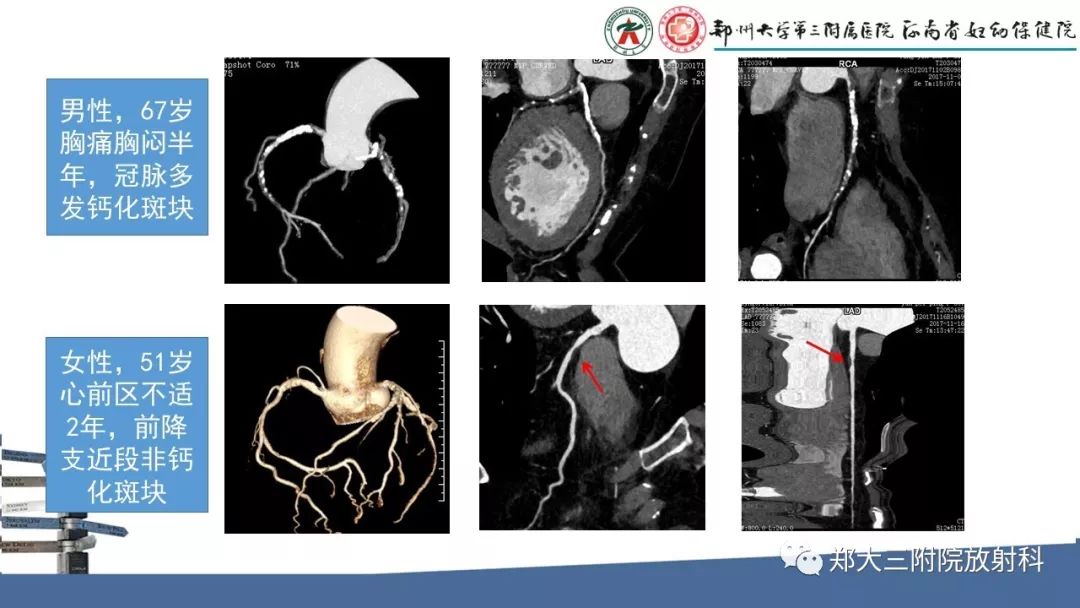 【PPT】冠状动脉CTA的临床应用