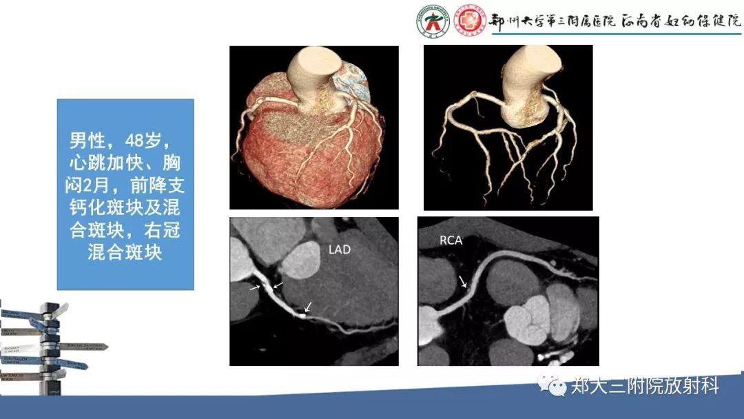 【PPT】冠状动脉CTA的临床应用