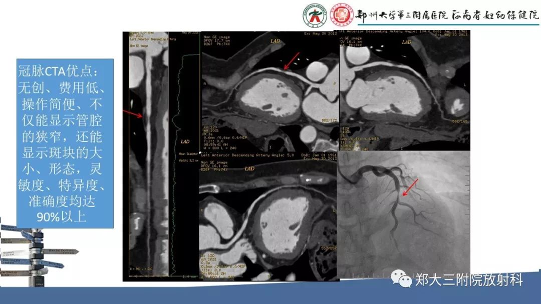 【PPT】冠状动脉CTA的临床应用