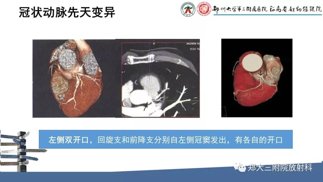 【PPT】冠状动脉CTA的临床应用