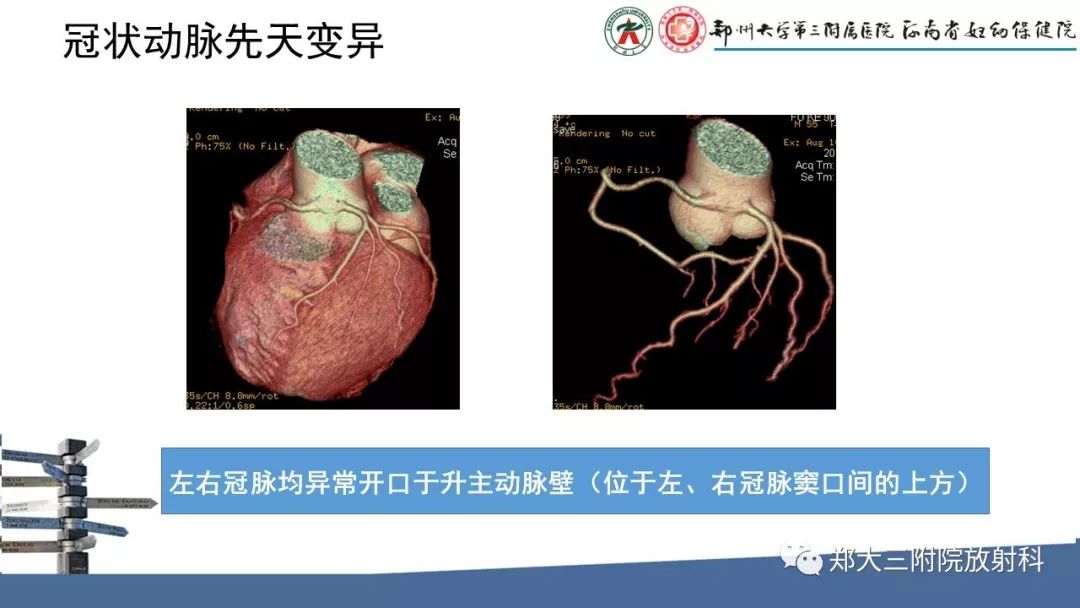 【PPT】冠状动脉CTA的临床应用