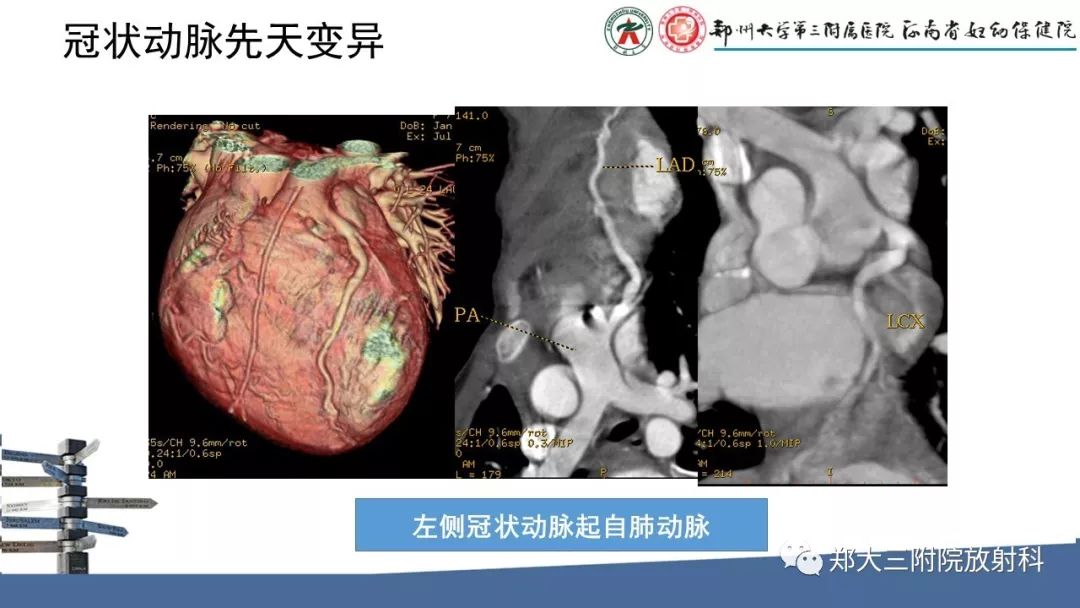 【PPT】冠状动脉CTA的临床应用