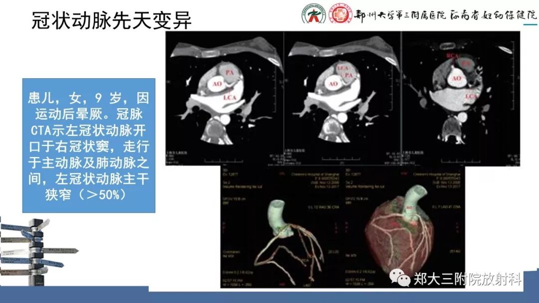 【PPT】冠状动脉CTA的临床应用