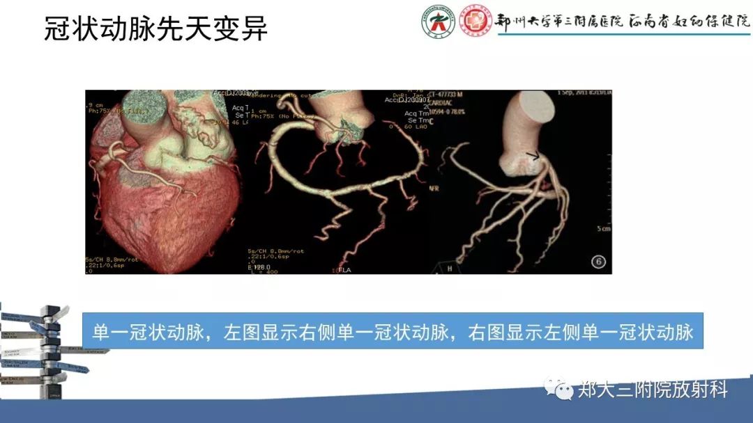 【PPT】冠状动脉CTA的临床应用