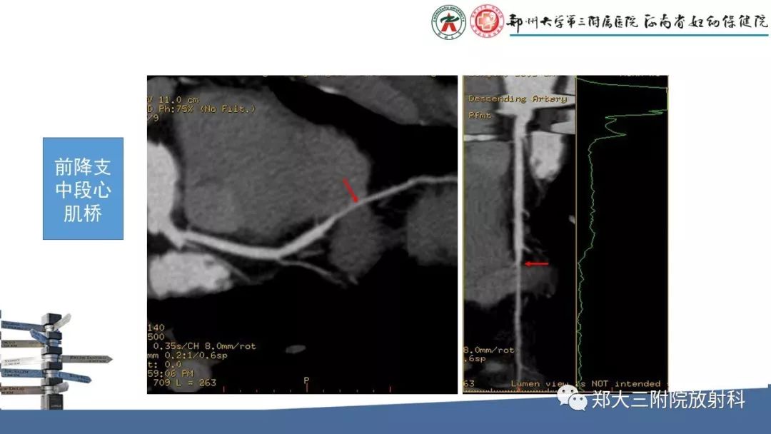 【PPT】冠状动脉CTA的临床应用