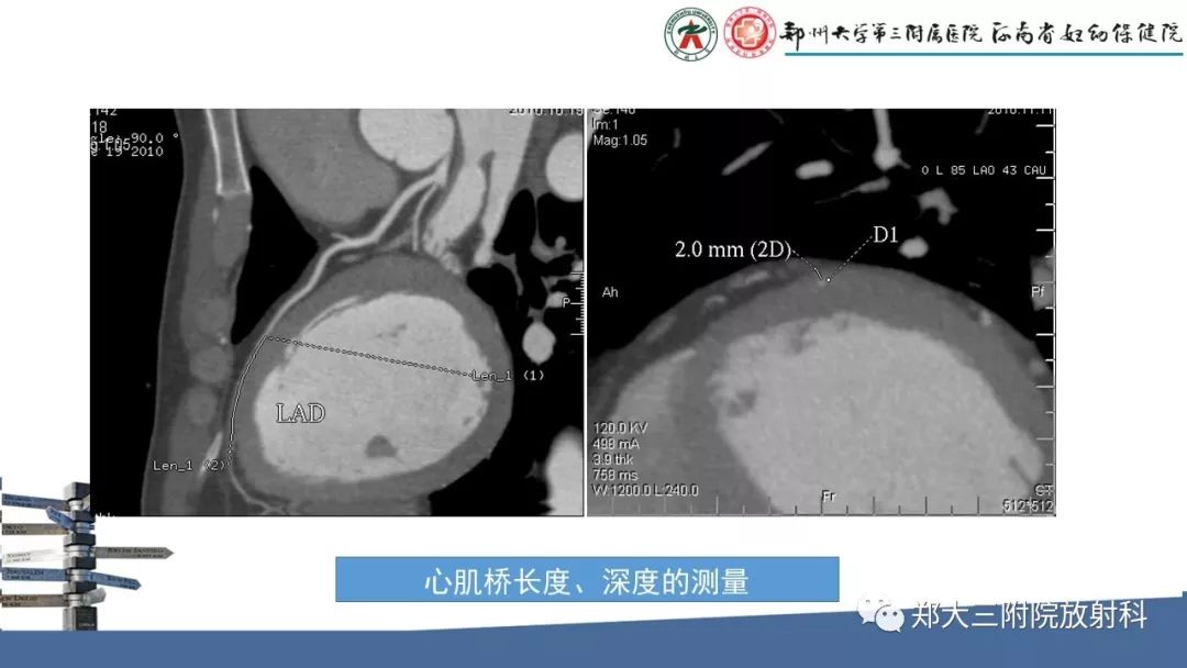 【PPT】冠状动脉CTA的临床应用