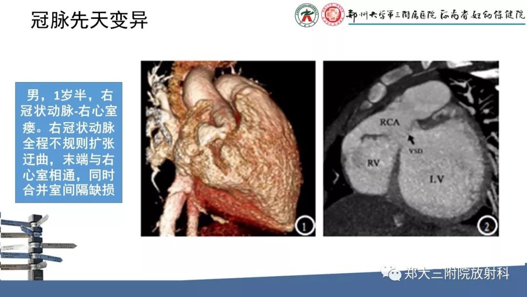 【PPT】冠状动脉CTA的临床应用