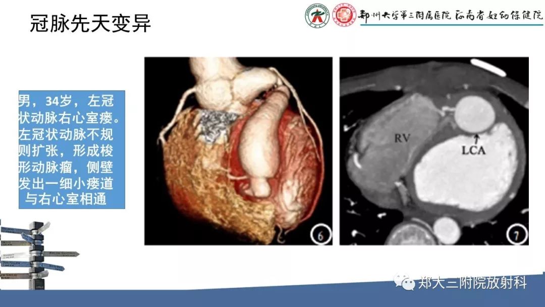 【PPT】冠状动脉CTA的临床应用