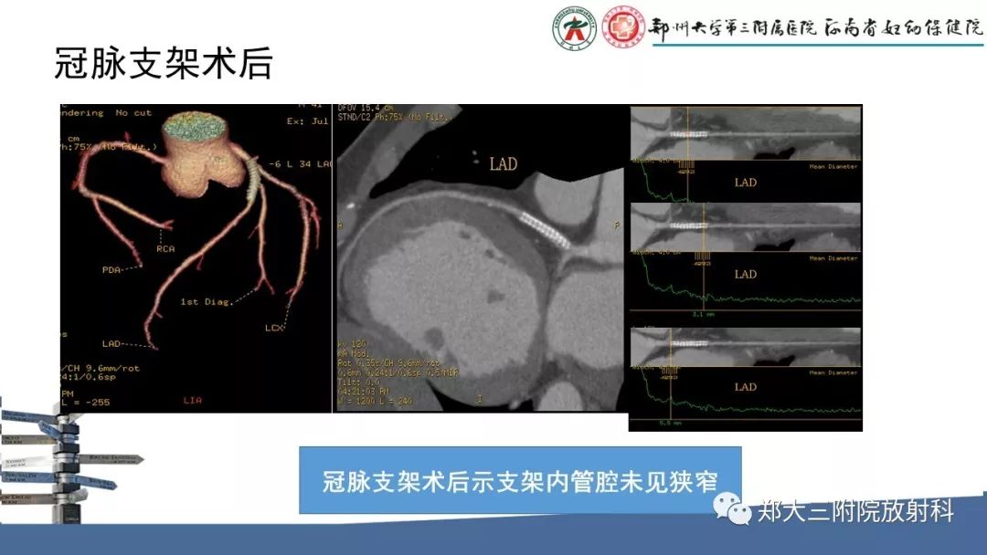 【PPT】冠状动脉CTA的临床应用