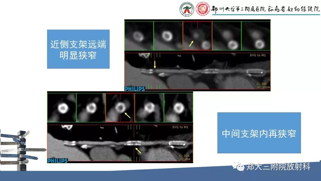 【PPT】冠状动脉CTA的临床应用