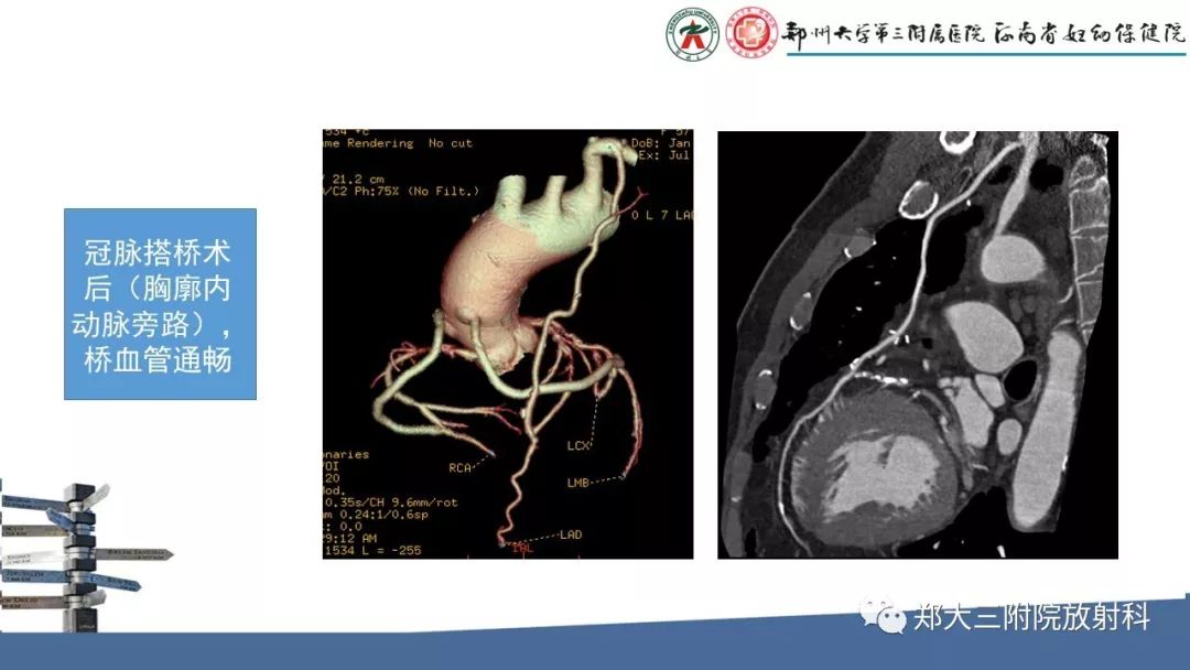 【PPT】冠状动脉CTA的临床应用