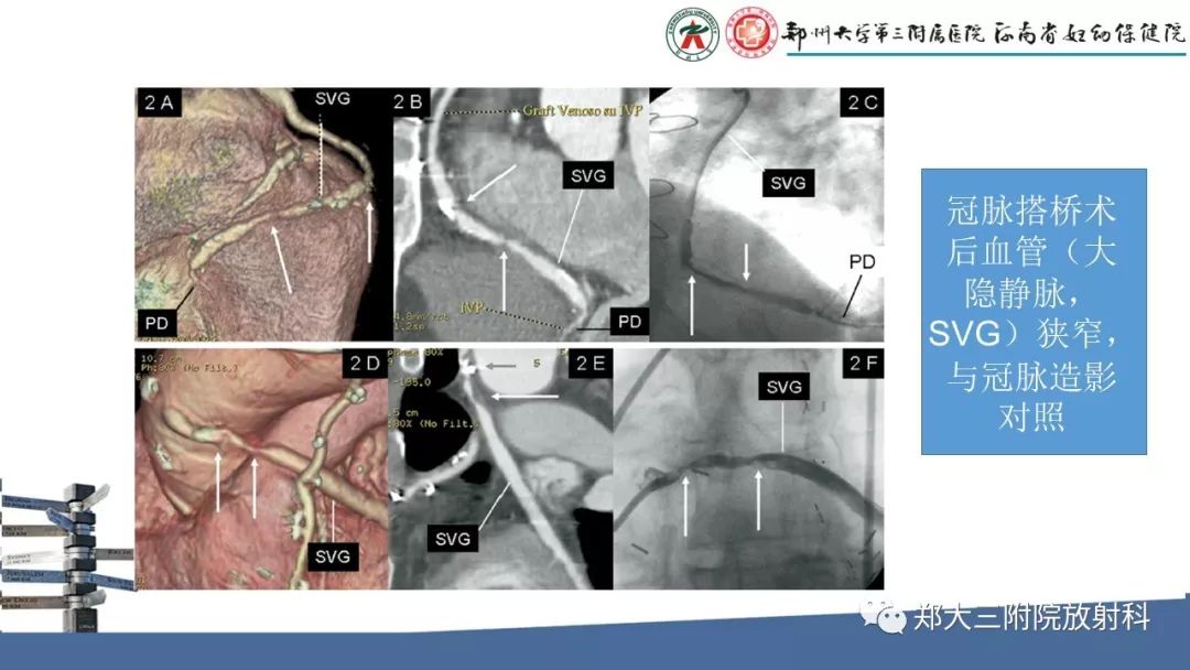 【PPT】冠状动脉CTA的临床应用