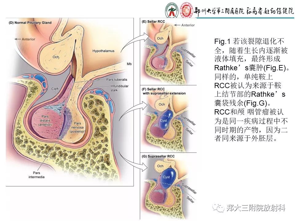 【PPT】Rathke 's 囊肿