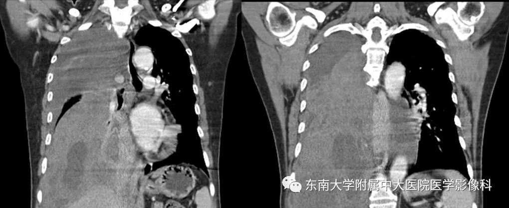 【PPT】胸膜孤立性纤维瘤